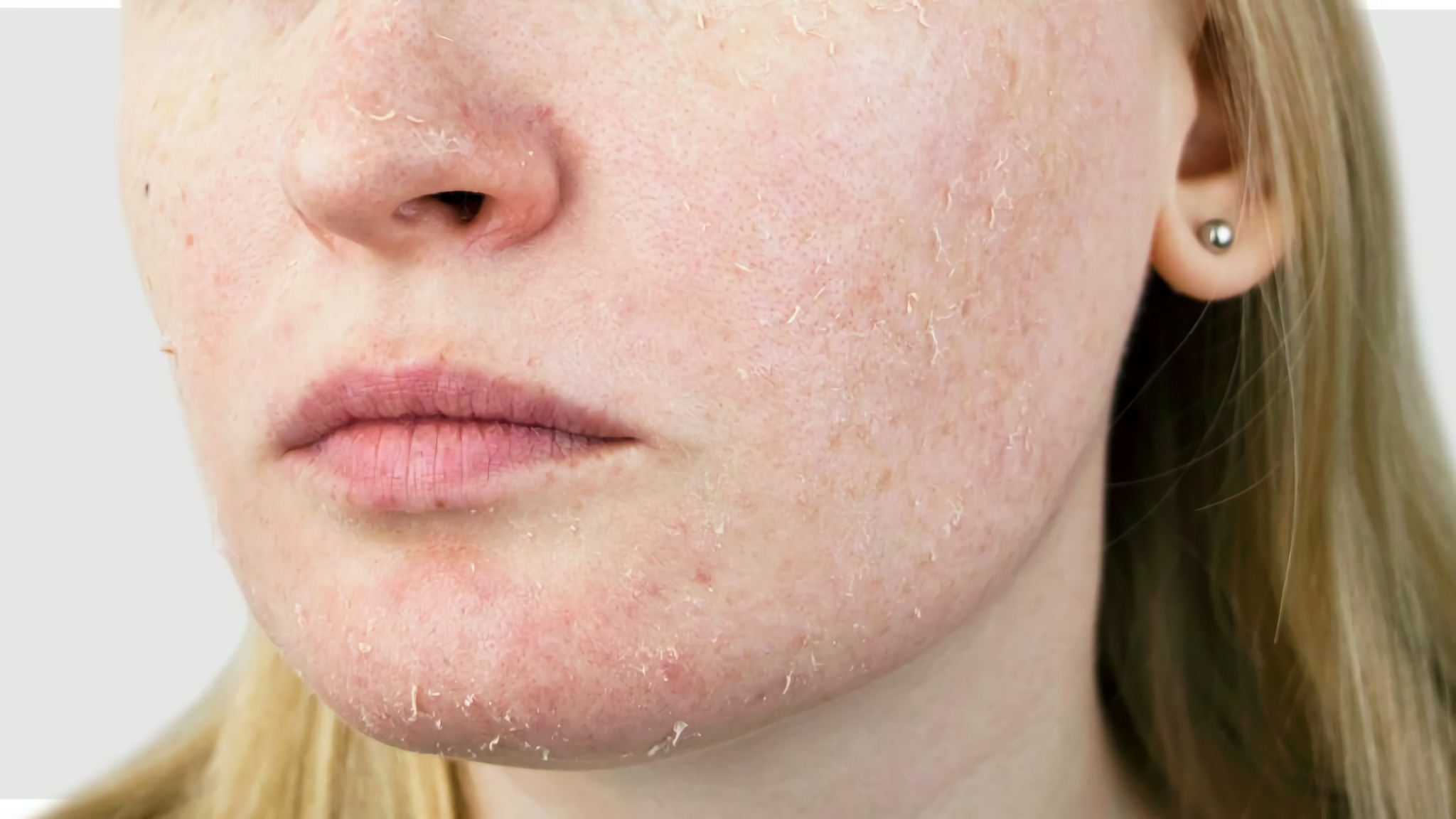 Почему шелушится кожа на лице: что делать и как избавиться?
